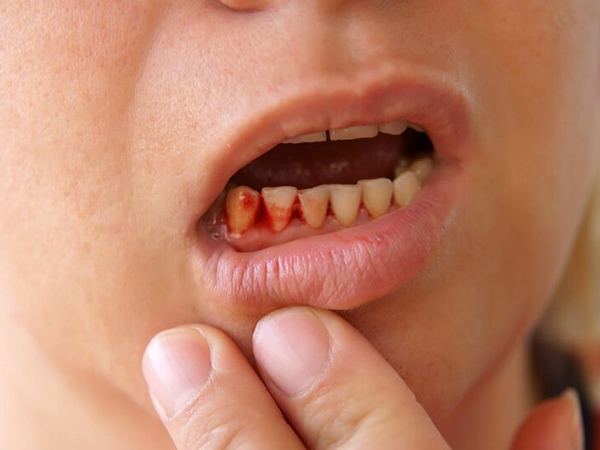 Giải mã nằm mơ thấy gãy răng chảy máu là điềm gì?