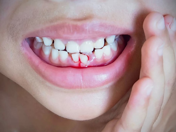Giải mã nằm mơ thấy gãy răng chảy máu là điềm gì?